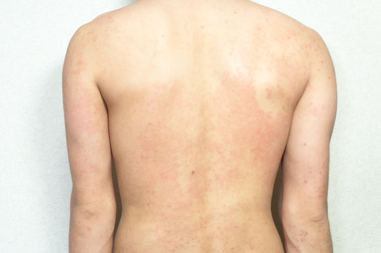 アトピー性皮膚炎による掻きむしりと色素沈着 お腹改善例Cocotiiココティー グリーンピール グランプリ連続受賞!!ニキビ、サメ肌、しみ、しわ、くすみなら肌ケアサロンCocotii