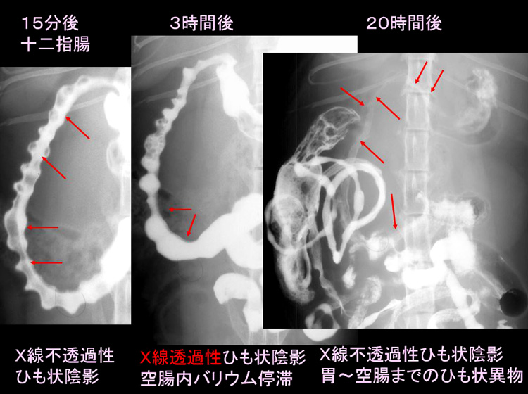 胃バリウム検査 上部消化管造影検査Upper Gastrointestinal SeriesUGI-神戸きしだクリニック 神戸市中央区