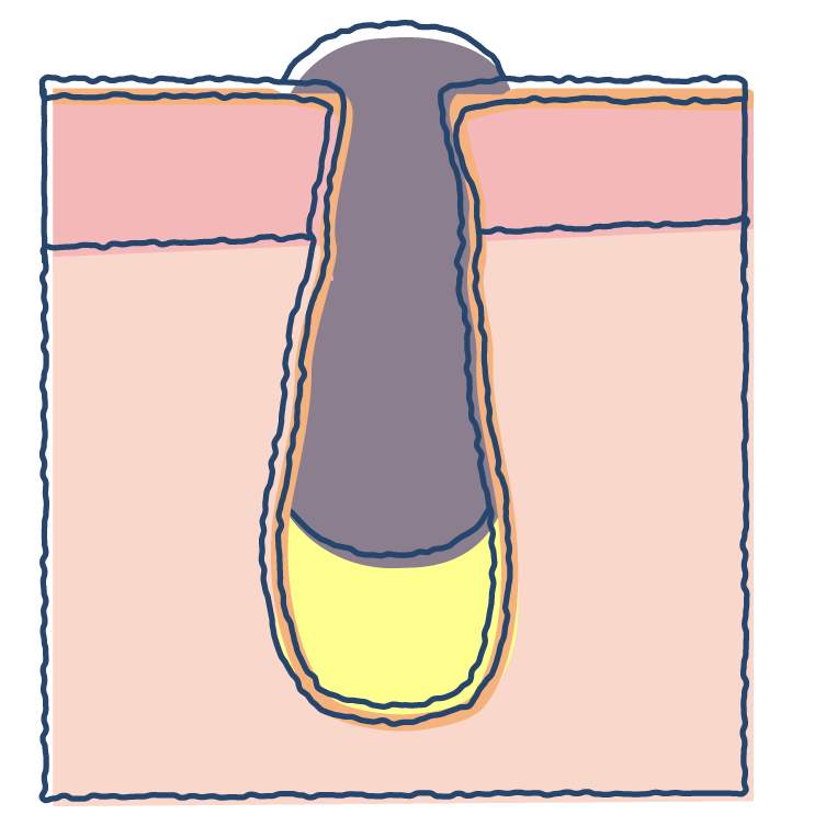 脇の膿疱皮膚トラブルの状態チェックヒフシルワカル