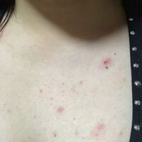 その他の皮膚のできものの症状 治療方法について - 渋谷駅前おおしま皮膚科 形成外科