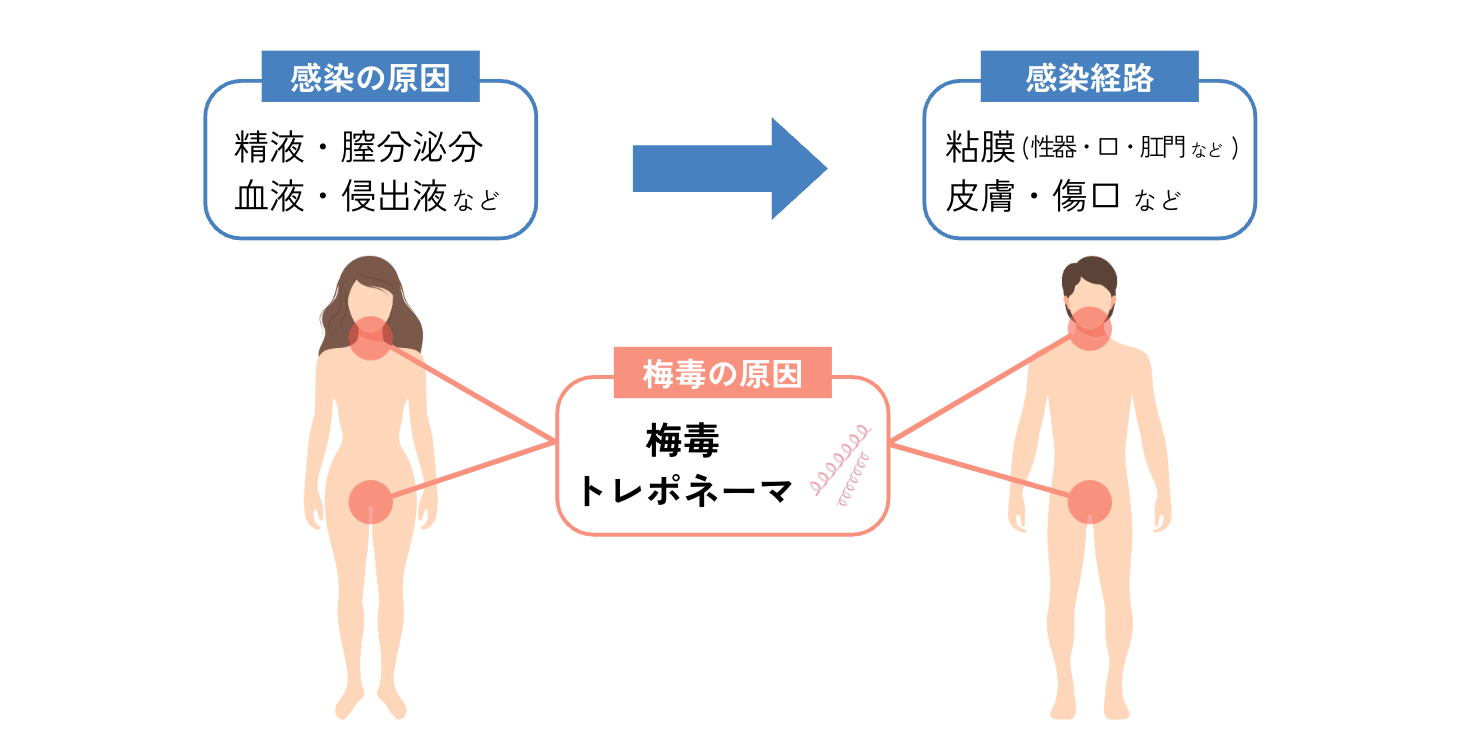 写真で比較 梅毒の初期症状かも？痛くない「しこり」や、かゆくない「発疹」は危険なサイン - 恵比寿のモイストクリニック