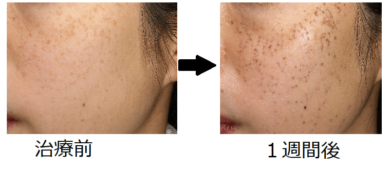 レーザー治療さの皮膚科クリニック 大阪府豊中市 皮膚科、美容皮膚科