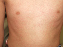 こどもに多いのどの病気 溶連菌感染症のおはなし感染症病気や治療・サポート情報を探す患者ご家族の皆さま塩野義製薬