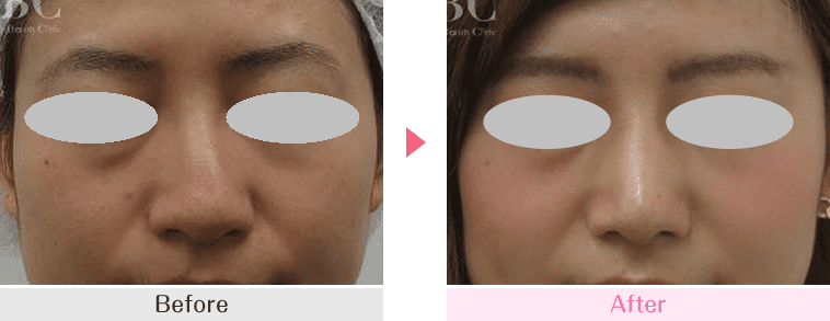 メンズの鼻整形 術後3ヶ月 斜鼻修正 貴族手術、肋軟骨による鼻中隔延長、耳介軟骨移植、鼻尖形成、骨切り幅寄せ、小鼻外側法RISK湾曲・鼻尖の硬さ・感染・鼻閉鼻フル金額鼻中隔軟骨使用：1,206,700円〜 肋軟骨使用：1,525,700円〜勤務地銀座 大阪