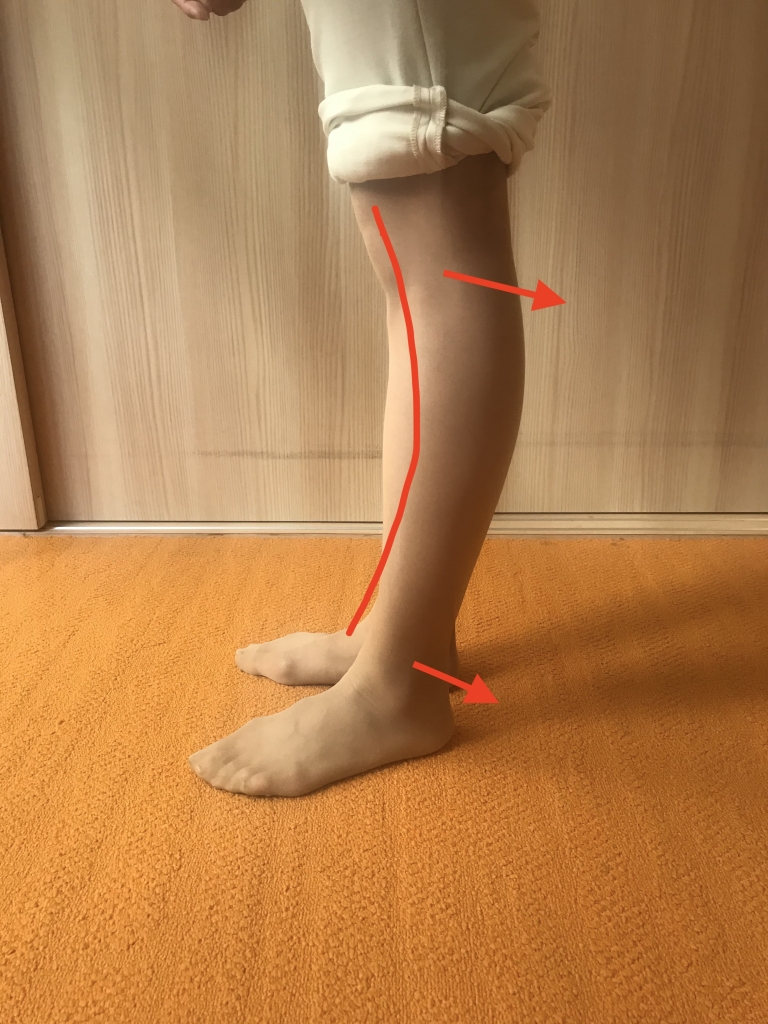 脳卒中 反張膝の原因は？ リハビリ 自主リハ千葉県 自費リハビリ施設 トータルリハビリテーション 「トリア」