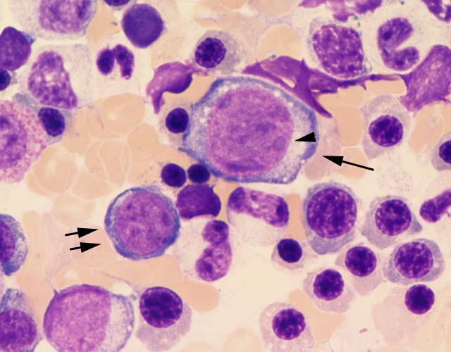 病気の説明特定非営利活動法人成人白血病治療共同研究機構 JALSG：Japan Adult Leukemia Study Group