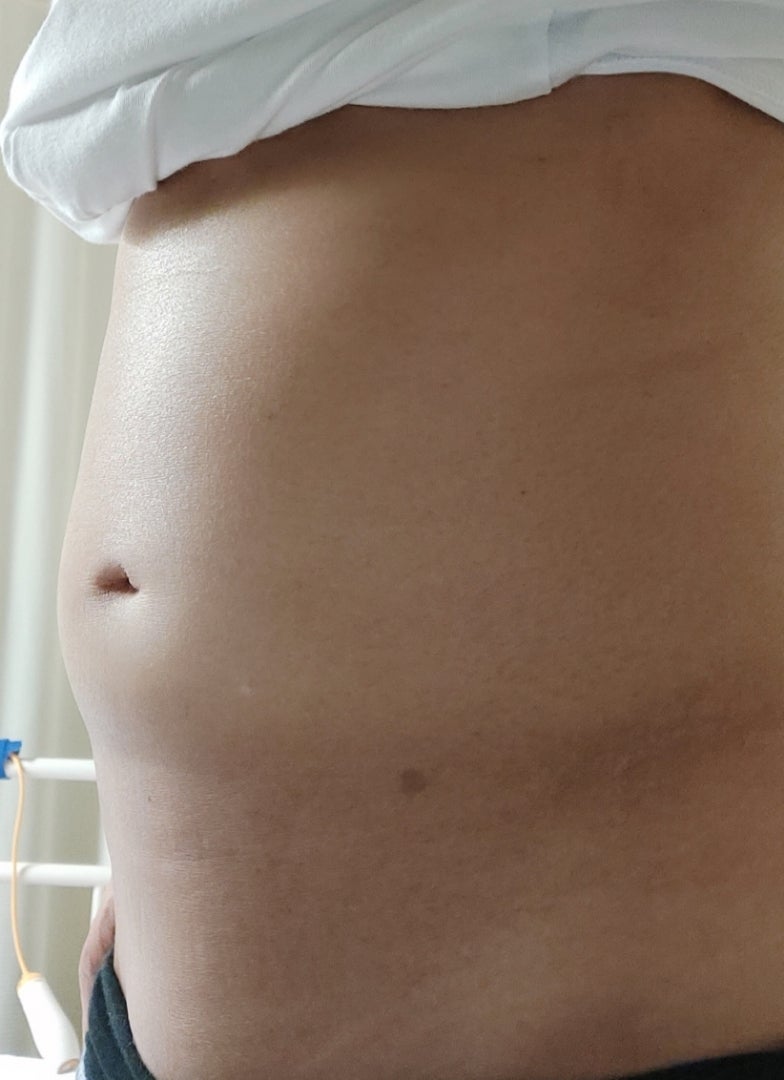 腹水history 2017 03 05更新病床六尺〜ステージ4トリネガ若年性乳がん再発転移しちゃった系OL