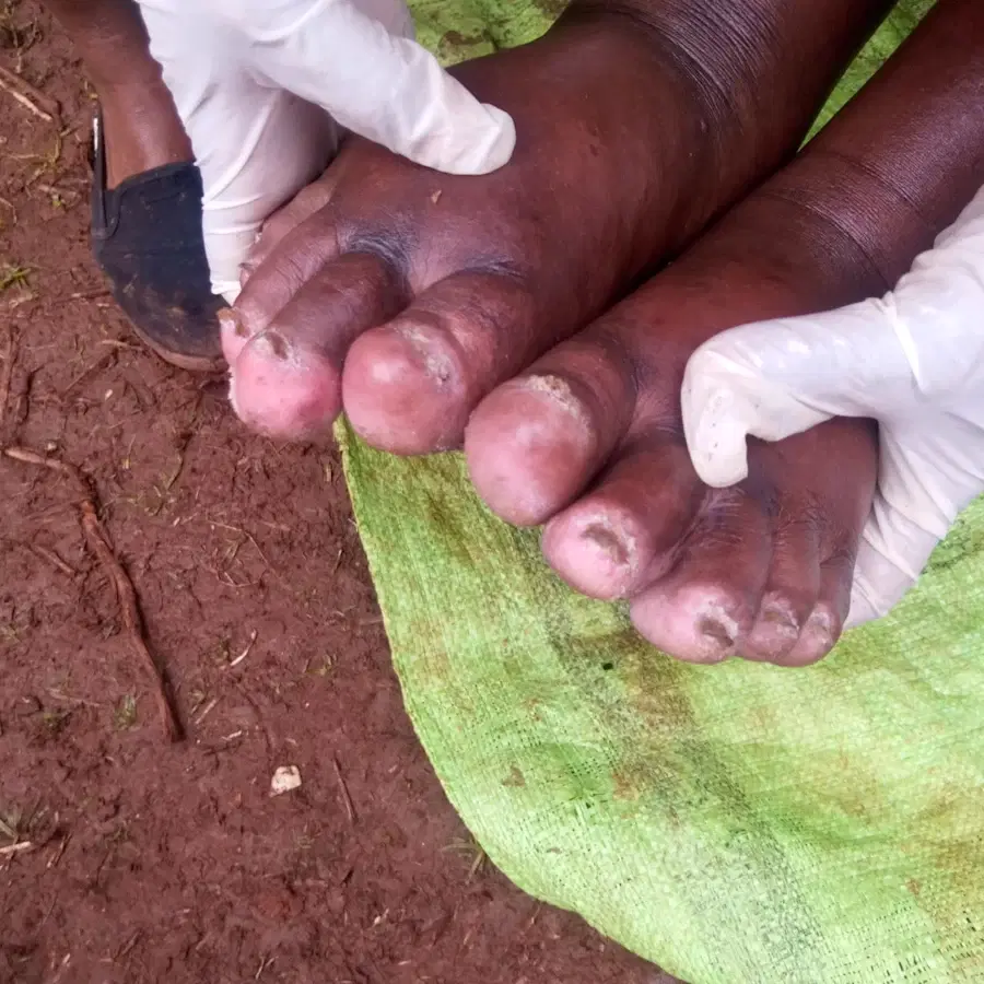 ケニアでスナノミ症治療プロジェクトを展開 貧困問題の解決が新たな目標に創大Days創価大学