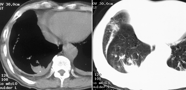 無気肺ってどんな病気？ - 東京田園調布駅前呼吸器内科・内科クリニック
