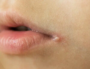 単純疱疹 疱疹性口内炎口腔病理基本画像アトラス