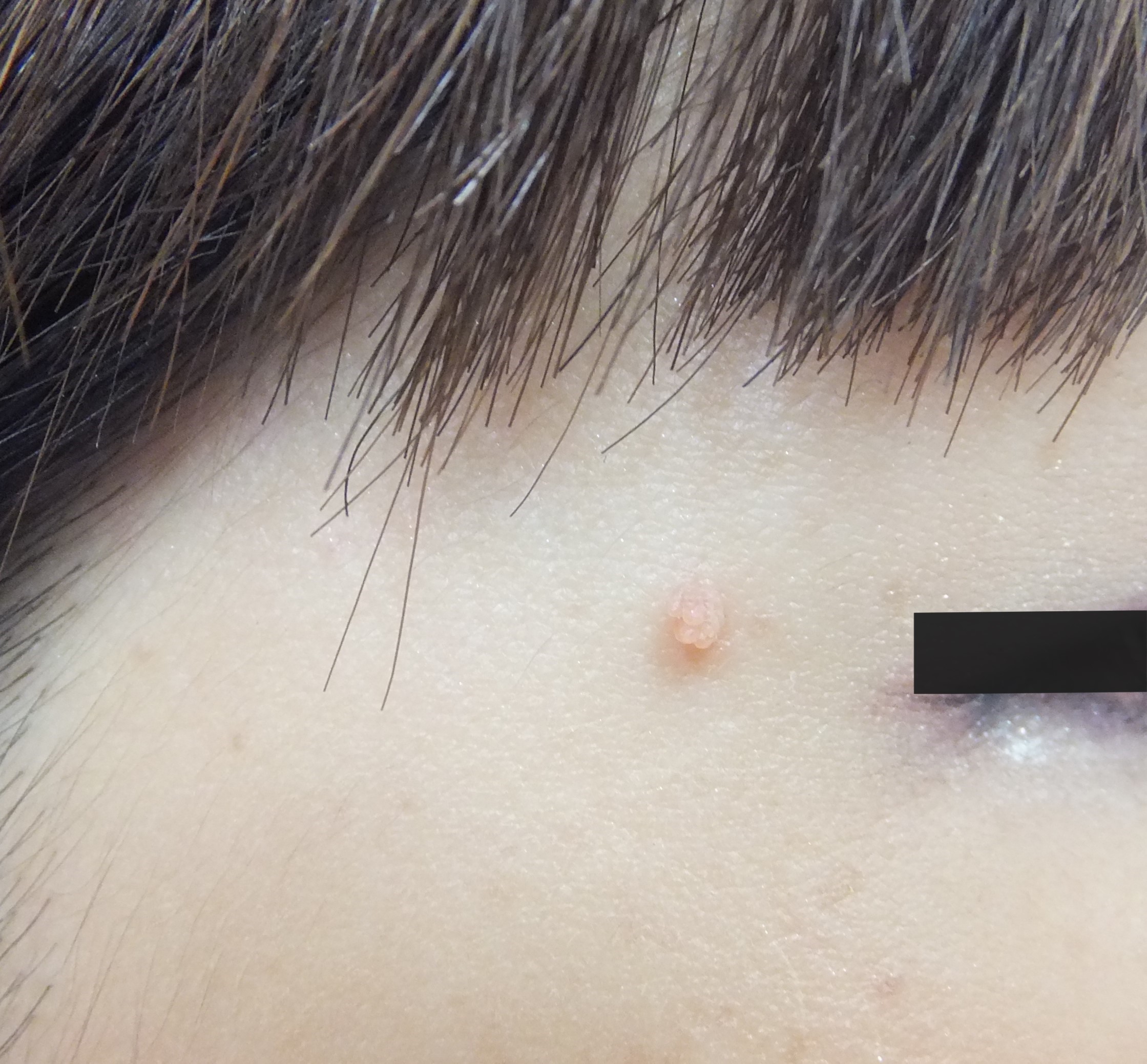 医師監修 首のイボは何でできるの？気になる原因やイボの種類・治療法などを解説！はじめての美容医療ジェイメック