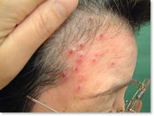 蜂窩織炎なった♿︎♿︎♿︎⚠️怪我の写真載せたよ😂気持ち悪いから気をつけてね I got injured last week but arleadygot well ♿︎ Thanks for everyone's support と理解。本当にすいませんでした。もーほんとに歩けないくらい痛かったんだから。みんな傷も車椅子も