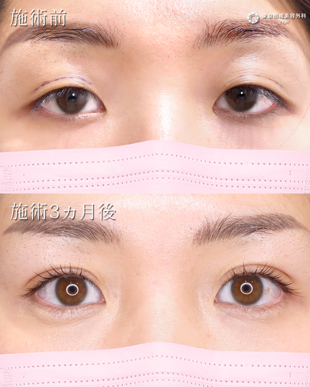 ガミースマイル ﻿ ﻿ ガミースマイルとは、笑った時に上顎の歯茎が見える口元のことを指しますが、ボトックス注射で手軽に改善する事ができます。﻿ ﻿ボトックス注射には上唇を動かす上唇挙筋を休ませる効果があり、注射後3～5日で効果が出ます。﻿ ﻿ ガミースマイルの