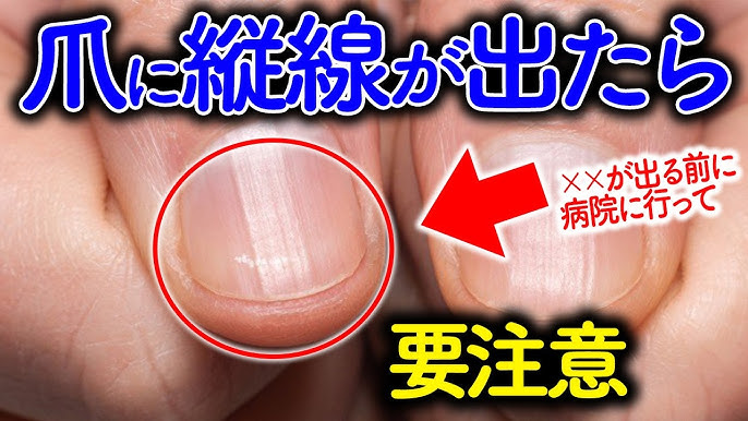 爪の病気 グリーンネイルにご注意ください佐世保市ネイルサロン 深爪育成ができるキヨノネイル