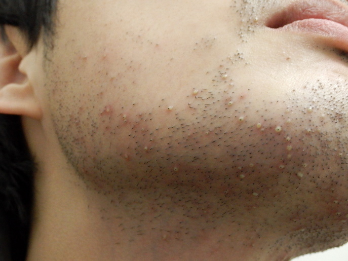 ヒゲ脱毛後に起きる「どろぼうヒゲ」の原因と対策メンズ脱毛百科事典 リンクスペディア