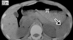 遅発性破裂をきたしたⅢ b 型鈍的脾損傷に対して 動脈塞栓術後の開腹術で全脾を温存した 1 例