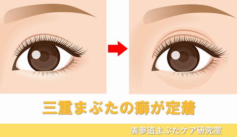 全切開 三重まぶた、さようなら 」に関する美容整形の症例写真の詳細新宿・池袋・大宮で人気の美容整形は東京シンデレラ美容外科