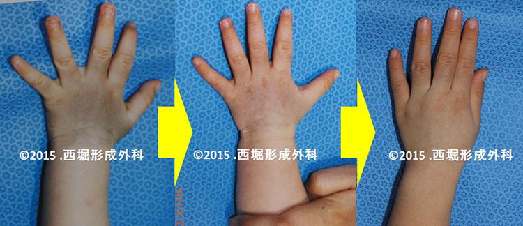 みやびクリニック赤ちゃんのあざ治療 保険適用 福岡の形成外科