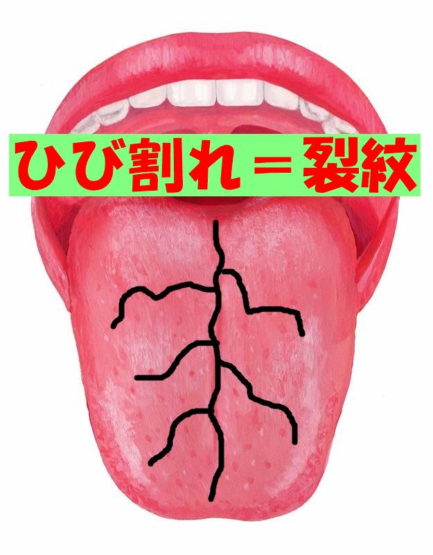 舌がひび割れしてる？考えられる原因や対策について解説します！ - 口腔外科DOC