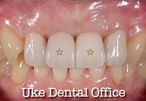 前歯がない時インプラントとブリッジ、どっちが良い？心斎橋クローバー歯科 よくあるご質問