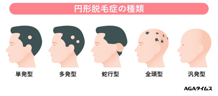 うなじの医療脱毛の効果や回数、痛みについて👆⁣ ⁣ 夏は人目に触れやすい「うなじ」のムダ毛💦⁣ そのぶんしっかりムダ毛ケアをしてあげると⁣ワンランク上の女性に見えます✨⁣ ⁣ そこでうなじの医療脱毛についてご紹介します！⁣ ⁣ 💡効果や回数について⁣ 他の脱毛部位と