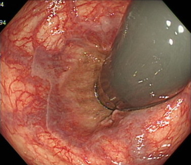 痔 痔核・痔瘻・裂肛 オリンパス おなかの健康ドットコム