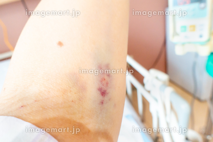 ぶつけた覚えがないのに内出血！原因と考えられる病気とは？ Doctors Me ドクターズミー