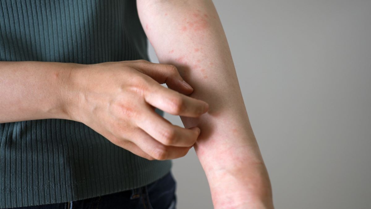 腕 上腕・手首・前腕 の丘疹皮膚トラブルの状態チェックヒフシルワカル