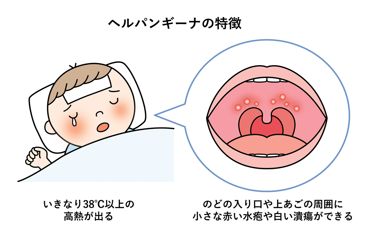 2023年 ヘルパンギーナの潜伏期間はどれくらい？熱やのどの痛みに効果のある市販薬も紹介 – EPARKくすりの窓口コラムヘルスケア情報