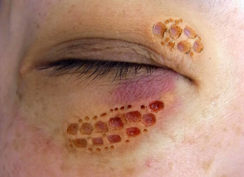 脂質異常症 従来の高脂血症