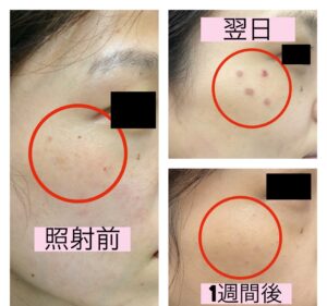 Qスイッチルビーレーザーでのシミ治療奈良 樹のひかり形成外科・皮ふ科