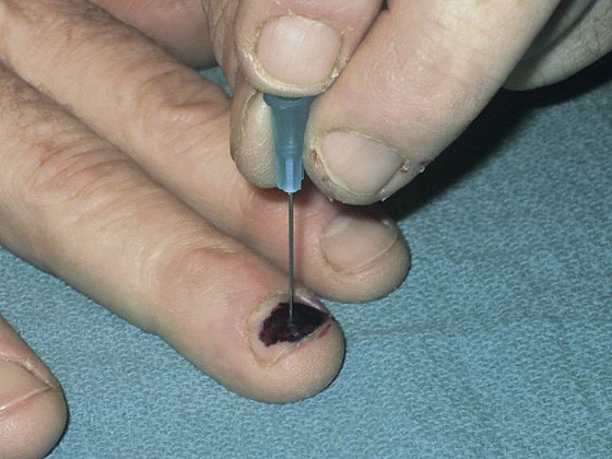 自己施術体験の例 指の血腫北九州八幡西の鍼灸 よつもと鍼灸院