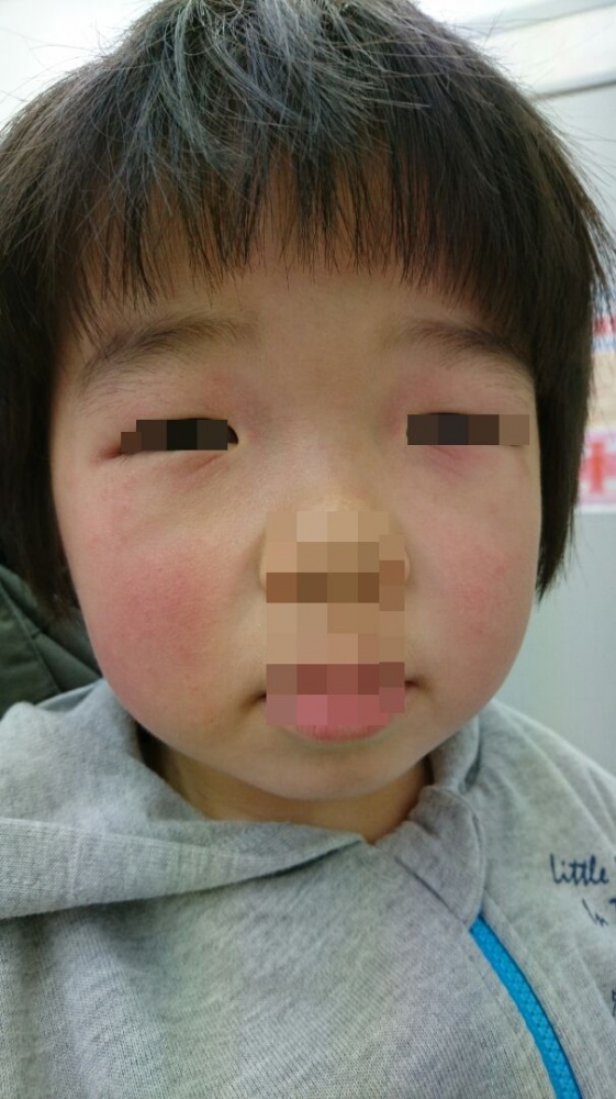 目の下ベビーコラーゲン0.2cc左のみ注入💉 直後のお写真です📷 腫れや内出血もほとんどなく、 注入直後から目の下のクマ、シワの改善が見られます🐻🫧☆ベビーコラーゲンとは？ 赤ちゃんのお肌に豊富に含まれているⅢ型コラーゲンを注入する治療です。 肌組織の再生を