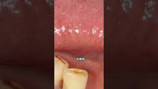 毛孔性扁平苔癬 LPP 性脱毛症の症状こばとも皮膚科栄駅 名古屋市栄区 徒歩2分