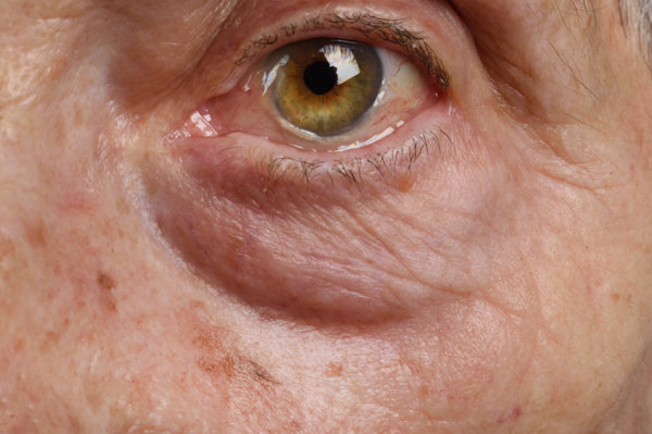 目の黄色がかった変色黄疸 — ストック写真 © Evgeniy_Bobkov204329212