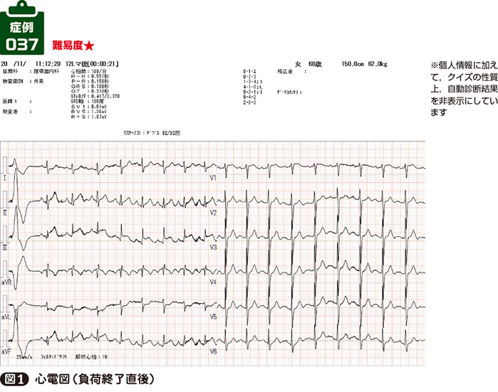 6.心筋梗塞の心電図変化誰でも分かる「心電図の簡単な読み方」 - みやけ内科・循環器科 総合内科のアプローチ