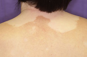 顔がまだらに「二度見されることもあったけど 」 10代発症、45歳で再発した「尋常性白斑」、今は美しい白髪で話題にまいどなニュース