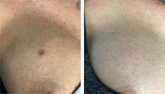 豊洲で上腕の皮膚腫瘍を切除！皮膚線維腫の切除 ほくろのようにも見えますが ～ここまできれいになります豊洲佐藤クリニック