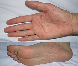 泌尿器科専門医 ドクター尾上の医療ブログ: 讀賣新聞 掲載 : 梅毒「まさか自分が」