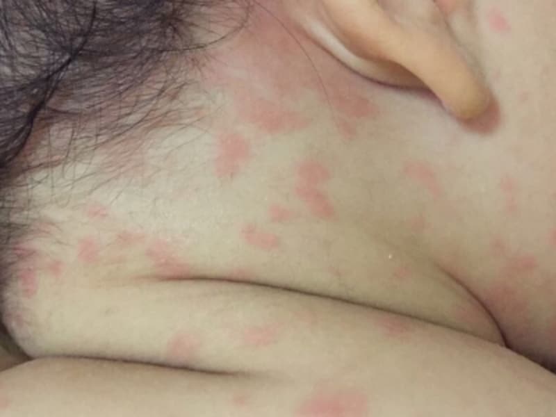 痒い！！大人の汗疹 あせも 予防と対策 健康管理検定 ：文部科学省後援