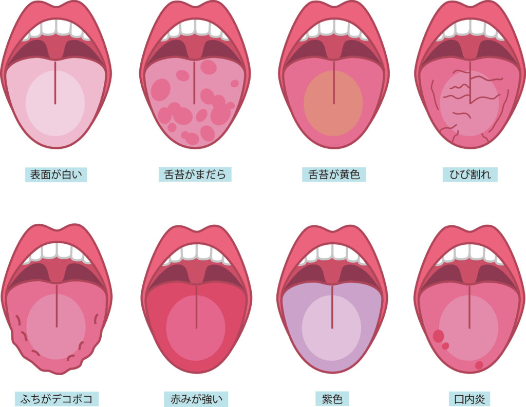 薬剤師が解説 舌のひび割れがあるときにおすすめの市販薬はどれ？9選を紹介 – EPARKくすりの窓口コラムヘルスケア情報