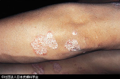 乾癬とは？ ただの乾燥肌だと見逃さず、乾癬を見分けるためのポイントあさ美皮フ科亀戸駅前