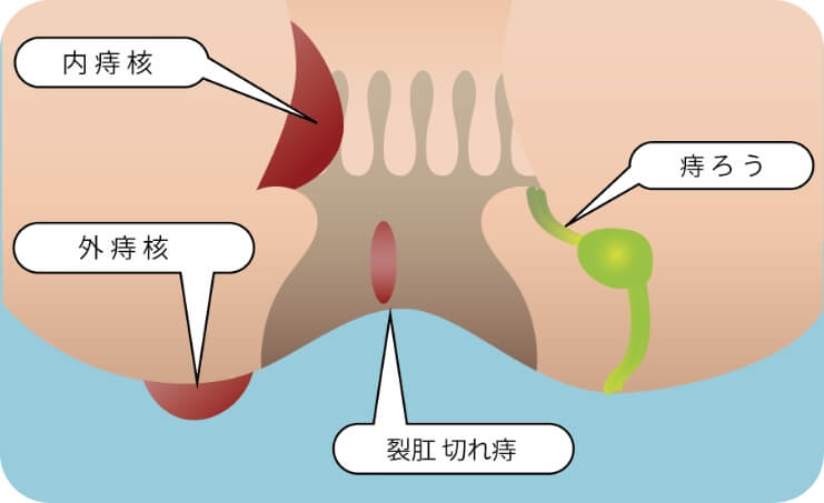 医師監修 痔のときに浣腸を使っても大丈夫？便秘を根本から改善する方法も紹介コラム便秘解消！ 酸化マグネシウムE便秘薬健栄製薬
