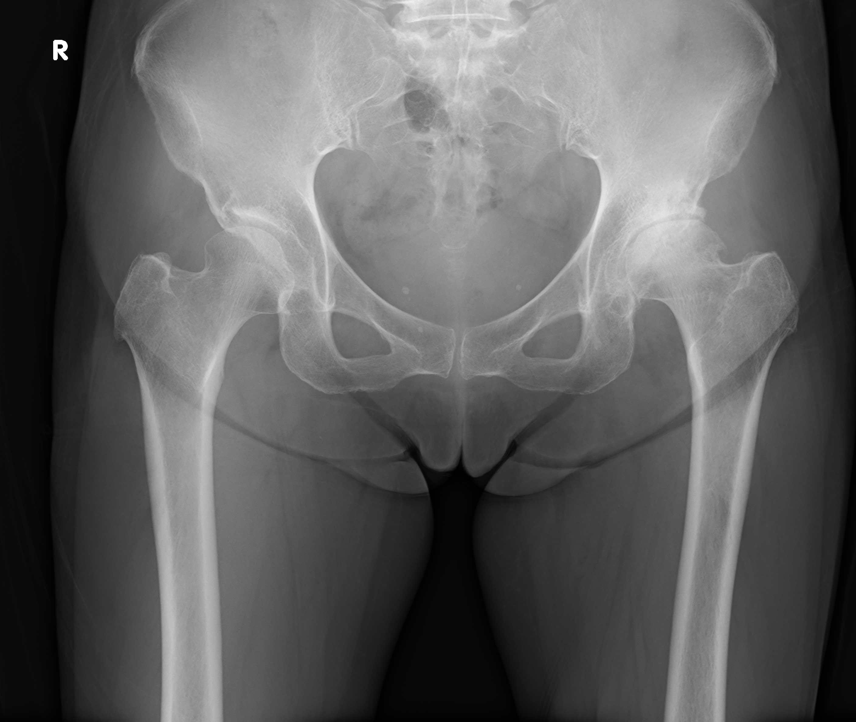 2019 01 09-10 大腿骨頸部骨折 ２