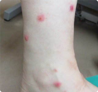 アブに刺された跡が腫れる・かゆい 見分け方と正しいケア方法 薬剤師執筆– EPARKくすりの窓口コラムヘルスケア情報