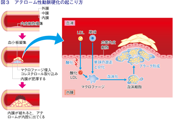 MRI MRA画像あり 脳動脈瘤の種類、頻度、好発部位、画像所見まとめ