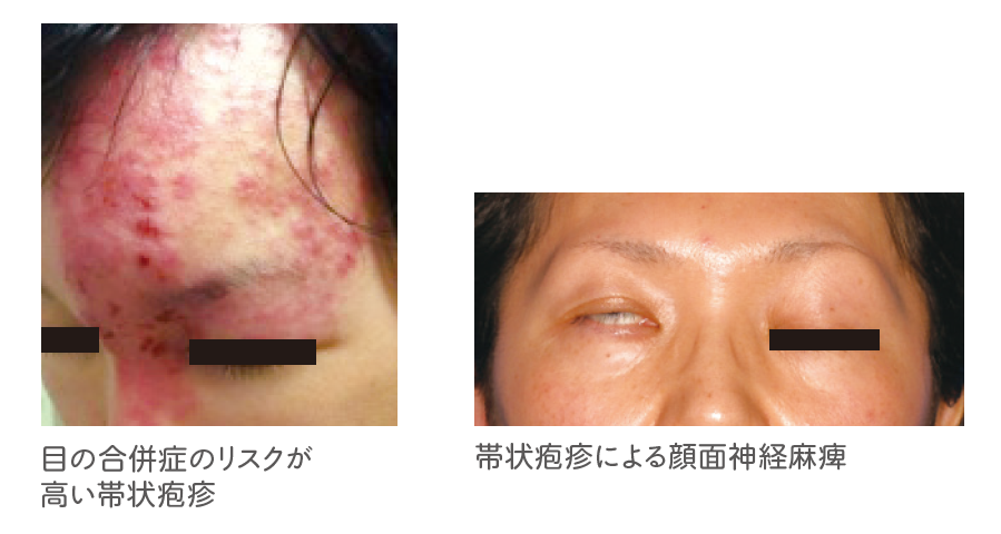 一生に一度だけ?」「体を一周したら 死⁉」“帯状疱疹”気になるウワサを“経験記者”が調べてみた静岡のニュースSBSNEWS静岡放送1ページ