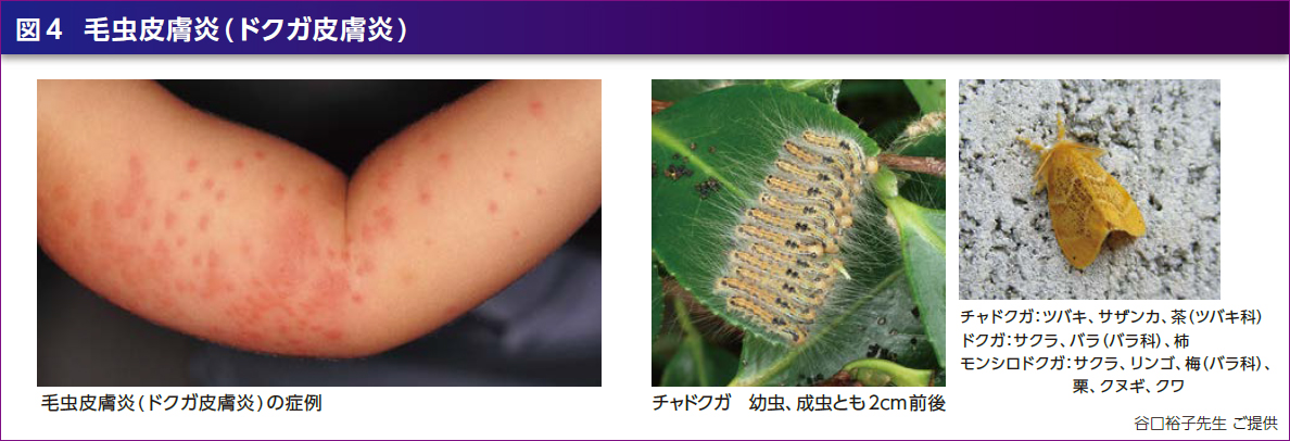 毛虫皮膚炎 茶毒蛾皮膚炎虎ノ門の美容整形なら駅前30秒にある虎ノ門皮フ科形成外科 美容医学センタ