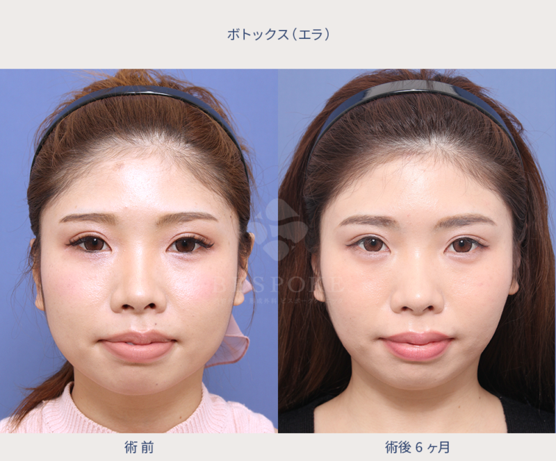 エラ取りボトックス ﻿ ﻿ エラの張ったお顔、ホームベース型の顔の輪郭を改善する施術です。﻿ ﻿ エラボトックス の治療は咬筋と呼ばれる筋肉 喰いしばった時にポコっと出っ張るエラの筋肉 にボトックスを注入することにより、筋肉を休ませエラ張りを改善し、細くしていく