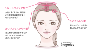 医師監修 女性のM字ハゲについて -公式 AGAスキンクリニックレディース